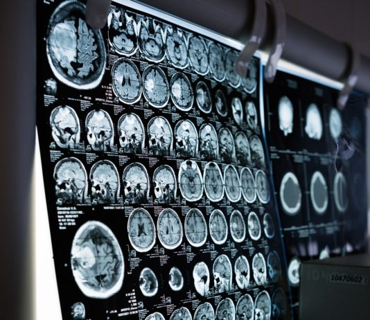 Covid-19: Forscher beobachten Veränderungen in den Gehirnen von infizierten Personen