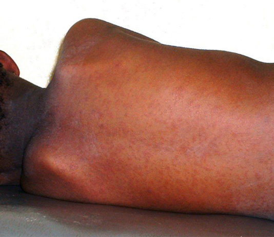 Fälle von Masern zu Jahresbeginn weltweit um fast 80% in die Höhe geschossen