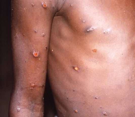 Frankreich bestätigt 51 Fälle von Affenpocken