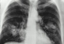 „Zwölf Jahre Überdosis“ – Wie in Saint-Brieuc Hunderte Patient:innen zu viel Strahlung erhielten Röntgen_Krebs