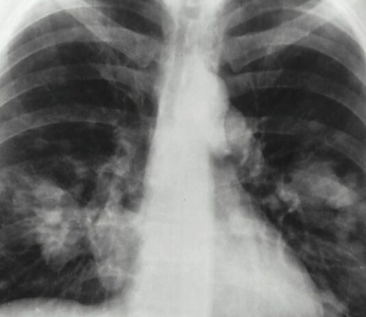 „Zwölf Jahre Überdosis“ – Wie in Saint-Brieuc Hunderte Patient:innen zu viel Strahlung erhielten Röntgen_Krebs